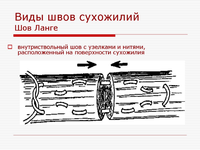 Виды швов сухожилий Шов Ланге  внутриствольный шов с узелками и нитями, расположенный на